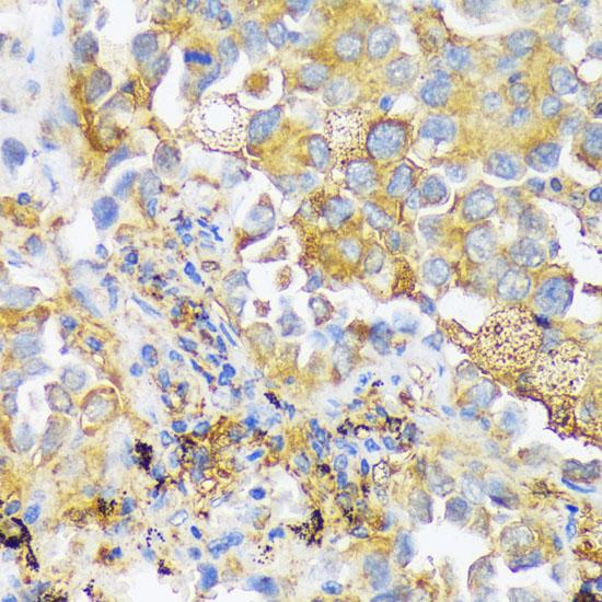 ZDHHC18 Antibody - Immunohistochemistry of paraffin-embedded Human lung cancer using ZDHHC18 Polyclonal Antibody at dilution of 1:100 (40x lens).