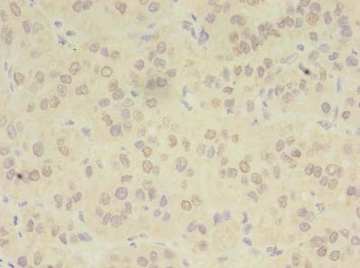 ZDHHC4 Antibody - Immunohistochemistry of paraffin-embedded human liver cancer using antibody at dilution of 1:100.