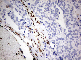 ZEB1 / AREB6 Antibody - IHC of paraffin-embedded Adenocarcinoma of Human breast tissue using anti-ZEB1 mouse monoclonal antibody. (Heat-induced epitope retrieval by 10mM citric buffer, pH6.0, 120°C for 3min).