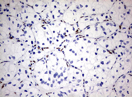 ZEB1 / AREB6 Antibody - IHC of paraffin-embedded Carcinoma of Human kidney tissue using anti-ZEB1 mouse monoclonal antibody. (Heat-induced epitope retrieval by 10mM citric buffer, pH6.0, 120°C for 3min).