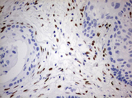 ZEB1 / AREB6 Antibody - IHC of paraffin-embedded Carcinoma of Human lung tissue using anti-ZEB1 mouse monoclonal antibody. (Heat-induced epitope retrieval by 10mM citric buffer, pH6.0, 120°C for 3min).