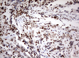 ZEB1 / AREB6 Antibody - IHC of paraffin-embedded Adenocarcinoma of Human endometrium tissue using anti-ZEB1 mouse monoclonal antibody. (Heat-induced epitope retrieval by 10mM citric buffer, pH6.0, 120°C for 3min).