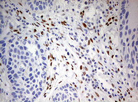 ZEB1 / AREB6 Antibody - IHC of paraffin-embedded Carcinoma of Human lung tissue using anti-ZEB1 mouse monoclonal antibody. (Heat-induced epitope retrieval by 10mM citric buffer, pH6.0, 120°C for 3min).