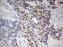 ZEB1 / AREB6 Antibody - IHC of paraffin-embedded Carcinoma of Human pancreas tissue using anti-ZEB1 mouse monoclonal antibody. (Heat-induced epitope retrieval by 10mM citric buffer, pH6.0, 120°C for 3min).