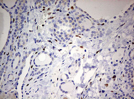 ZEB1 / AREB6 Antibody - IHC of paraffin-embedded Human thyroid tissue using anti-ZEB1 mouse monoclonal antibody. (Heat-induced epitope retrieval by 10mM citric buffer, pH6.0, 120°C for 3min).