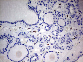 ZEB1 / AREB6 Antibody - IHC of paraffin-embedded Carcinoma of Human thyroid tissue using anti-ZEB1 mouse monoclonal antibody. (Heat-induced epitope retrieval by 10mM citric buffer, pH6.0, 120°C for 3min).