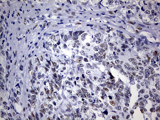 ZEB1 / AREB6 Antibody - IHC of paraffin-embedded Adenocarcinoma of Human endometrium tissue using anti-ZEB1 mouse monoclonal antibody. (Heat-induced epitope retrieval by 1 mM EDTA in 10mM Tris, pH8.5, 120°C for 3min).