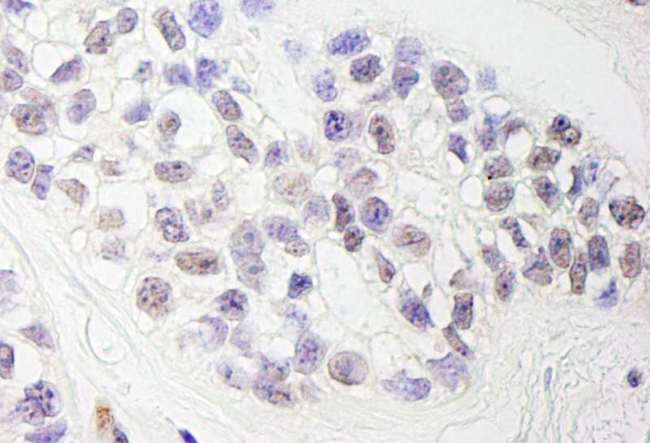 ZEB1 / AREB6 Antibody - Detection of Human ZEB1 by Immunohistochemistry. Sample: FFPE section of human breast carcinoma. Antibody: Affinity purified rabbit anti-ZEB1 used at a dilution of 1:1000 (0.2 ug/ml). Detection: DAB.