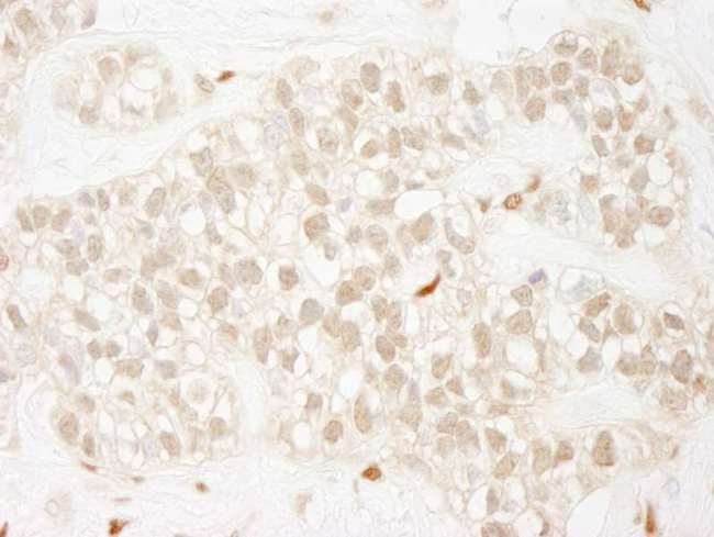 ZEB1 / AREB6 Antibody - Detection of Human ZEB1 by Immunohistochemistry. Sample: FFPE section of human breast carcinoma. Antibody: Affinity purified rabbit anti-ZEB1 used at a dilution of 1:250.
