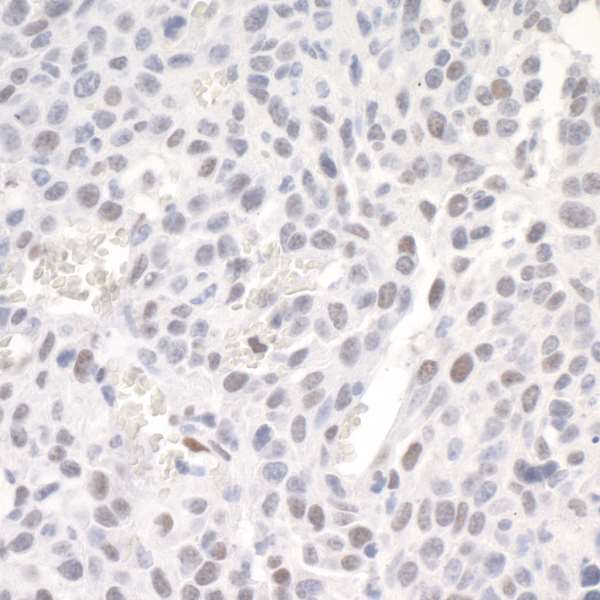 ZEB1 / AREB6 Antibody - Detection of mouse ZEB1 by immunohistochemistry. Sample: FFPE section of mouse CT26 tumor. Antibody: Affinity purified rabbit anti ZEB1 used at a dilution of 1:500. Detection: DAB
