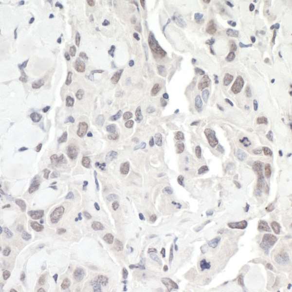 ZEB1 / AREB6 Antibody - Detection of human ZEB1 by immunohistochemistry. Sample: FFPE section of human breast carcinoma. Antibody:Affinity purified rabbit anti ZEB1 used at a dilution of 1:500. Detection: DAB