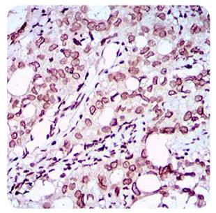 ZEB1 / AREB6 Antibody - Immunohistochemistry: ZEB1 Antibody (2A8A6) - IHC analysis of paraffin-embedded human cervical cancer tissues with DAB staining.  This image was taken for the unconjugated form of this product. Other forms have not been tested.