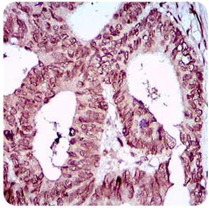 ZEB1 / AREB6 Antibody - Immunohistochemistry: ZEB1 Antibody (2A8A6) - IHC analysis of paraffin-embedded human rectum cancer tissues with DAB staining.  This image was taken for the unconjugated form of this product. Other forms have not been tested.