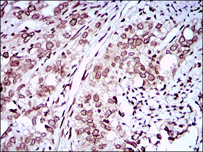 ZEB1 / AREB6 Antibody - IHC of paraffin-embedded cervical cancer tissues using ZEB1 mouse monoclonal antibody with DAB staining.