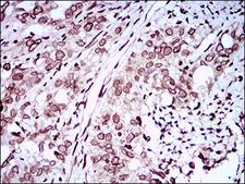 ZEB1 / AREB6 Antibody - IHC of paraffin-embedded cervical cancer tissues using ZEB1 mouse monoclonal antibody with DAB staining.