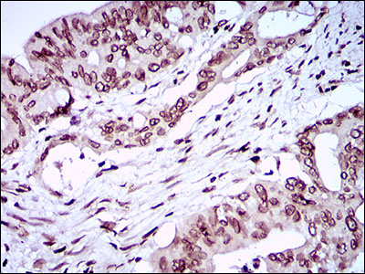 ZEB1 / AREB6 Antibody - IHC of paraffin-embedded rectum cancer tissues using ZEB1 mouse monoclonal antibody with DAB staining.