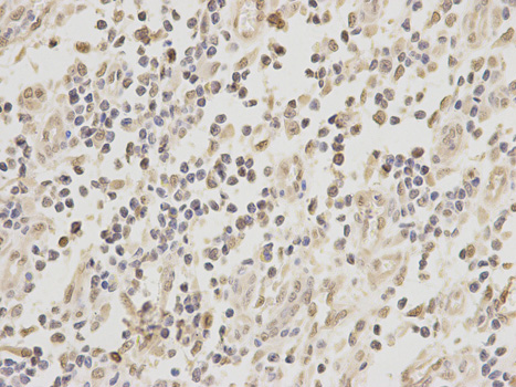 ZEB1 / AREB6 Antibody - Immunohistochemistry of paraffin-embedded human stomach cancer using ZEB1 antibody at dilution of 1:100 (400x lens).