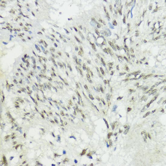 ZEB1 / AREB6 Antibody - Immunohistochemistry of paraffin-embedded Human gastric cancer using ZEB1 Polyclonal Antibody at dilution of 1:200 (40x lens).