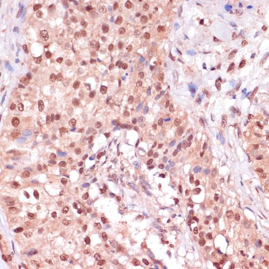 ZEB1 / AREB6 Antibody - Immunohistochemistry of paraffin-embedded Human breast cancer using ZEB1 Polyclonal Antibody at dilution of 1:100 (40x lens).