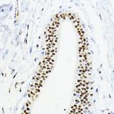 ZEB1 / AREB6 Antibody - Immunohistochemistry of paraffin-embedded Human mammary cancer using ZEB1 Polyclonal Antibody at dilution of 1:200 (40x lens).
