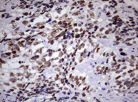 ZEB2 / SIP-1 Antibody - IHC of paraffin-embedded Adenocarcinoma of Human endometrium tissue using anti-ZEB2 mouse monoclonal antibody. (Heat-induced epitope retrieval by 10mM citric buffer, pH6.0, 120°C for 3min).