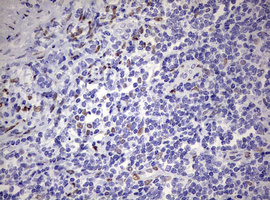 ZEB2 / SIP-1 Antibody - IHC of paraffin-embedded Human lymphoma tissue using anti-ZEB2 mouse monoclonal antibody. (Heat-induced epitope retrieval by 10mM citric buffer, pH6.0, 120°C for 3min).