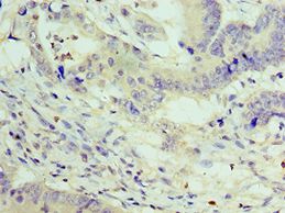 ZEB2 / SIP-1 Antibody - Immunohistochemistry of paraffin-embedded human colon cancer using antibody at 1:100 dilution.