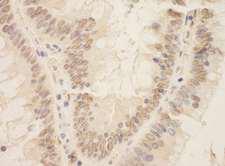 ZEB2 / SIP-1 Antibody - Detection of Human SIP1 by Immunohistochemistry. Sample: FFPE section of human colon carcinoma. Antibody: Affinity purified rabbit anti-SIP1 used at a dilution of 1:200 (1 ug/ml). Detection: DAB.