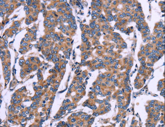 ZEB2 / SIP-1 Antibody - Immunohistochemistry of paraffin-embedded Human breast cancer using ZEB2 Polyclonal Antibody at dilution of 1:60.