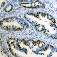 ZEB2 / SIP-1 Antibody - Immunohistochemical analysis of ZEB2 staining in human colon cancer formalin fixed paraffin embedded tissue section. The section was pre-treated using heat mediated antigen retrieval with sodium citrate buffer (pH 6.0). The section was then incubated with the antibody at room temperature and detected using an HRP conjugated compact polymer system. DAB was used as the chromogen. The section was then counterstained with hematoxylin and mounted with DPX.