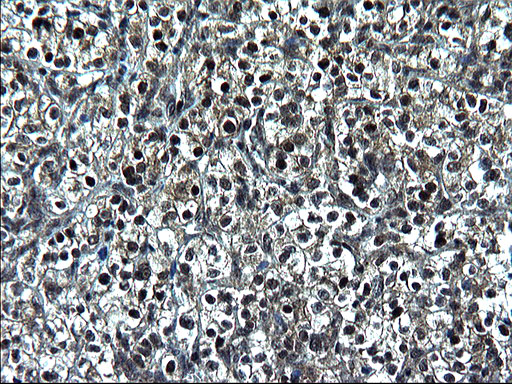 ZFAND3 / TEX27 Antibody - IHC of paraffin-embedded Carcinoma of Human kidney tissue using anti-ZFAND3 mouse monoclonal antibody. (Heat-induced epitope retrieval by 1 mM EDTA in 10mM Tris, pH8.5, 120°C for 3min).
