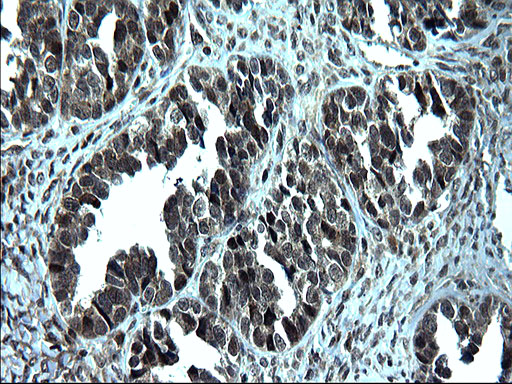 ZFAND3 / TEX27 Antibody - IHC of paraffin-embedded Adenocarcinoma of Human ovary tissue using anti-ZFAND3 mouse monoclonal antibody. (Heat-induced epitope retrieval by 1 mM EDTA in 10mM Tris, pH8.5, 120°C for 3min).