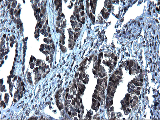 ZFAND3 / TEX27 Antibody - IHC of paraffin-embedded Adenocarcinoma of Human ovary tissue using anti-ZFAND3 mouse monoclonal antibody. (Heat-induced epitope retrieval by 1 mM EDTA in 10mM Tris, pH8.5, 120°C for 3min).