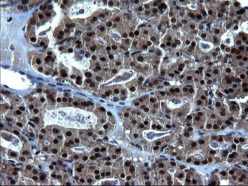 ZFAND3 / TEX27 Antibody - IHC of paraffin-embedded Carcinoma of Human thyroid tissue using anti-ZFAND3 mouse monoclonal antibody. (Heat-induced epitope retrieval by 1 mM EDTA in 10mM Tris, pH8.5, 120°C for 3min).