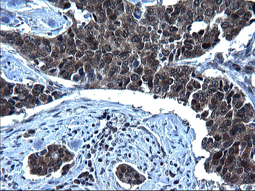 ZFAND3 / TEX27 Antibody - IHC of paraffin-embedded Carcinoma of Human bladder tissue using anti-ZFAND3 mouse monoclonal antibody. (Heat-induced epitope retrieval by 1 mM EDTA in 10mM Tris, pH8.5, 120°C for 3min).