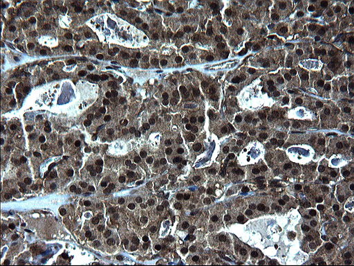 ZFAND3 / TEX27 Antibody - IHC of paraffin-embedded Carcinoma of Human thyroid tissue using anti-ZFAND3 mouse monoclonal antibody. (Heat-induced epitope retrieval by 1 mM EDTA in 10mM Tris, pH8.5, 120°C for 3min).