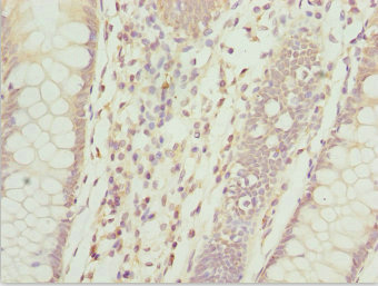 ZFAND3 / TEX27 Antibody - Immunohistochemistry of paraffin-embedded human colon cancer at dilution 1:100
