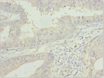 ZFAND3 / TEX27 Antibody - Immunohistochemistry of paraffin-embedded human endometrial cancer at dilution 1:100