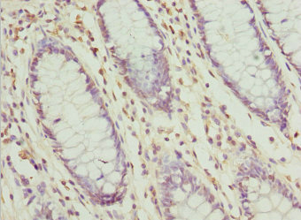 ZFAND3 / TEX27 Antibody - Immunohistochemistry of paraffin-embedded human colon cancer at dilution 1:100