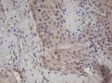 ZFAND5 Antibody - IHC of paraffin-embedded Carcinoma of Human lung tissue using anti-ZFAND5 mouse monoclonal antibody.