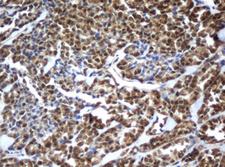 ZFAND5 Antibody - IHC of paraffin-embedded Carcinoma of Human thyroid tissue using anti-ZFAND5 mouse monoclonal antibody.