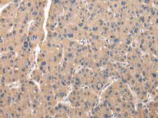 ZFAND5 Antibody - Immunohistochemistry of paraffin-embedded Human thyroid cancer tissue  using ZFAND5 Polyclonal Antibody at dilution of 1:35(×200)