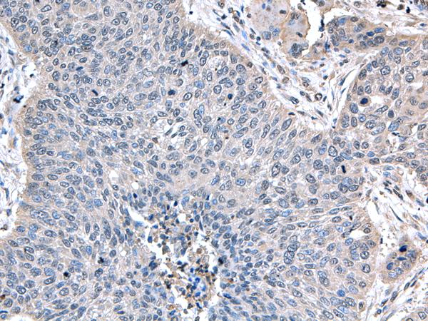 ZFAND5 Antibody - Immunohistochemistry of paraffin-embedded Human lung cancer tissue  using ZFAND5 Polyclonal Antibody at dilution of 1:35(×200)