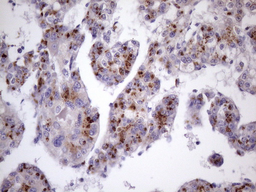 Zfp105 / ZNF35 Antibody - Immunohistochemical staining of paraffin-embedded Carcinoma of Human liver tissue using anti-ZNF35 mouse monoclonal antibody. (Heat-induced epitope retrieval by 1 mM EDTA in 10mM Tris, pH8.5, 120C for 3min. (1:150)