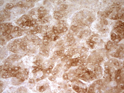 Zfp105 / ZNF35 Antibody - Immunohistochemical staining of paraffin-embedded Carcinoma of Human liver tissue using anti-ZNF35 mouse monoclonal antibody. (Heat-induced epitope retrieval by 1 mM EDTA in 10mM Tris, pH8.5, 120C for 3min,