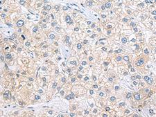 Zfp105 / ZNF35 Antibody - Immunohistochemistry of paraffin-embedded Human liver cancer tissue  using ZNF35 Polyclonal Antibody at dilution of 1:40(×200)