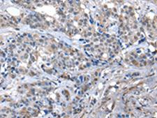 ZFP2 Antibody - Immunohistochemistry of paraffin-embedded Human breast cancer tissue  using ZFP2 Polyclonal Antibody at dilution of 1:40(×200)