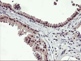 ZFP36 / Tristetraprolin Antibody - IHC of paraffin-embedded Human breast tissue using anti-ZFP36 mouse monoclonal antibody. (Heat-induced epitope retrieval by 10mM citric buffer, pH6.0, 100C for 10min).