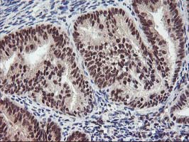 ZFP36 / Tristetraprolin Antibody - IHC of paraffin-embedded Adenocarcinoma of Human endometrium tissue using anti-ZFP36 mouse monoclonal antibody. (Heat-induced epitope retrieval by 10mM citric buffer, pH6.0, 100C for 10min).