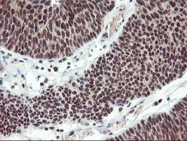 ZFP36 / Tristetraprolin Antibody - IHC of paraffin-embedded Carcinoma of Human bladder tissue using anti-ZFP36 mouse monoclonal antibody. (Heat-induced epitope retrieval by 10mM citric buffer, pH6.0, 100C for 10min).